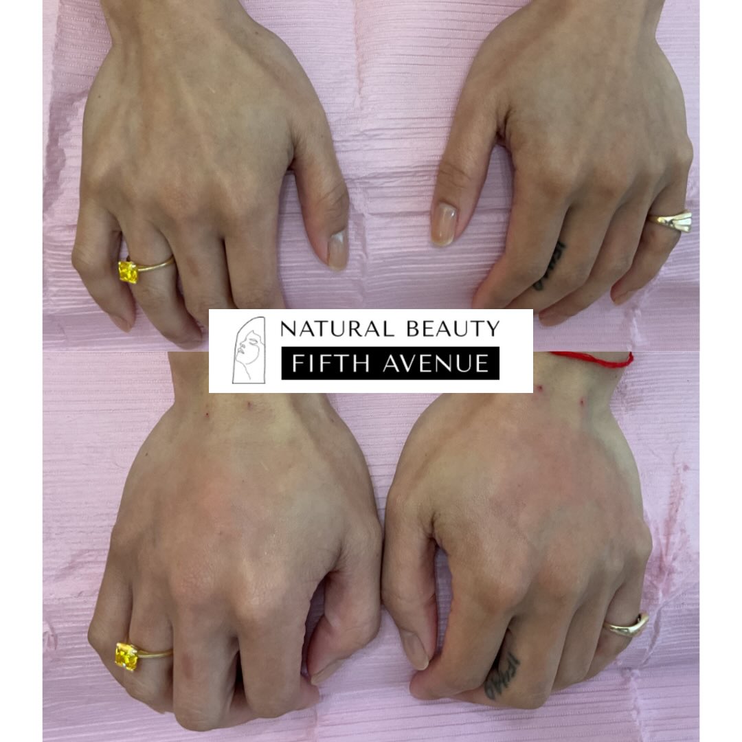 Four hands displayed on a lavender surface showing fuller, more defined hand texture after dermal fillers treatment at Natural Beauty Fifth Avenue